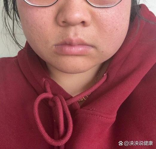 牙齿矫正后脸肿了？是正常反应还是需警惕？-图2