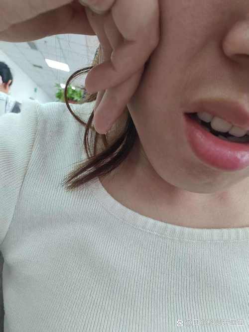 牙齿矫正后脸肿了？是正常反应还是需警惕？-图3