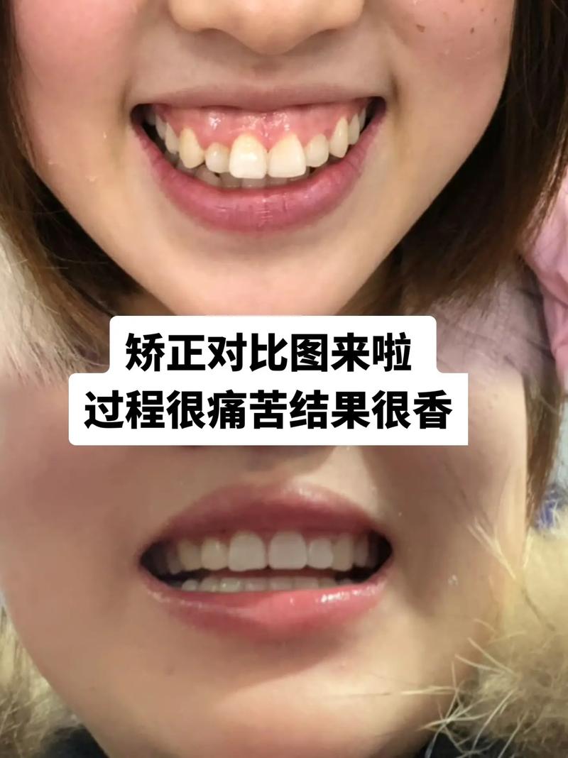 牙齿矫正后悔哭？后悔效果不如预期？还是过程太痛苦？-图1