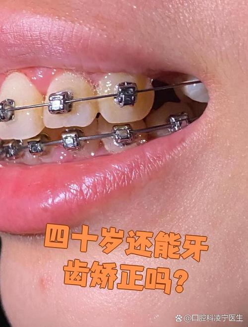 22岁矫正牙齿还来得及吗？效果会受年龄影响吗？-图2