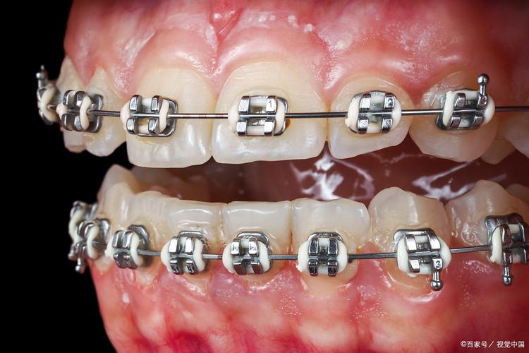 普通矫正器矫正牙齿效果如何？适合哪些情况？-图2