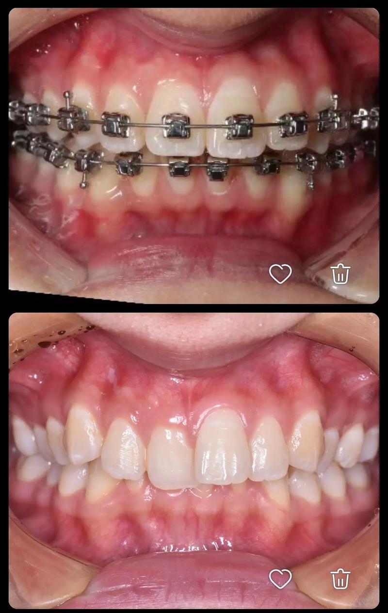 矫正后深覆盖为何出现？如何应对？-图1