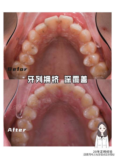 矫正后深覆盖为何出现？如何应对？-图3