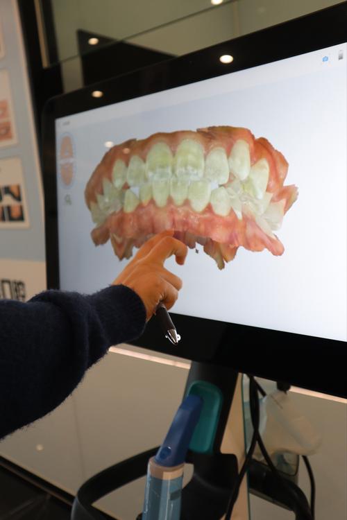 正夫口腔牙齿矫正效果如何？适合哪些人群做？优势有哪些？-图1