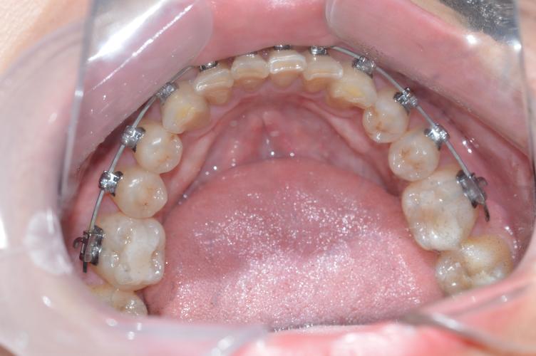 广州牙齿矫正选康圆靠谱吗?效果和口碑如何?-图1 广州牙齿矫正选康圆靠谱吗?效果和口碑如何?-图1