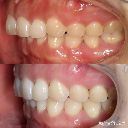 牙齿矫正2年多了还没结束?效果到底怎么样?-图1 牙齿矫正2年多了还没结束?效果到底怎么样?-图1