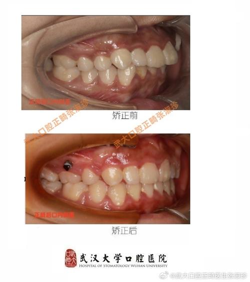 武汉牙齿矫正手术效果如何?安全吗?价格大概多少?-图3 武汉牙齿矫正手术效果如何?安全吗?价格大概多少?-图3