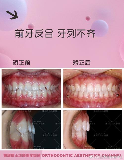 牙齿矫正时长是否会因智齿位置或拔除情况而变化？-图2