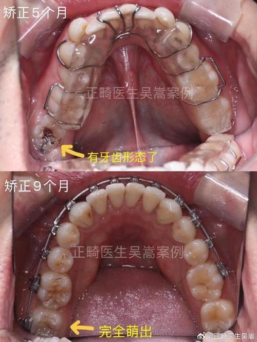 牙齿矫正时长是否会因智齿位置或拔除情况而变化？-图3