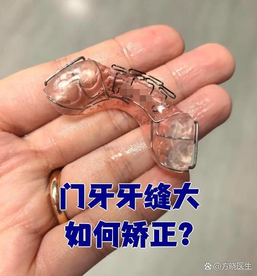 牙齿活动了,还能通过矫正来改善吗?-图2 牙齿活动了,还能通过矫正来改善吗?-图2