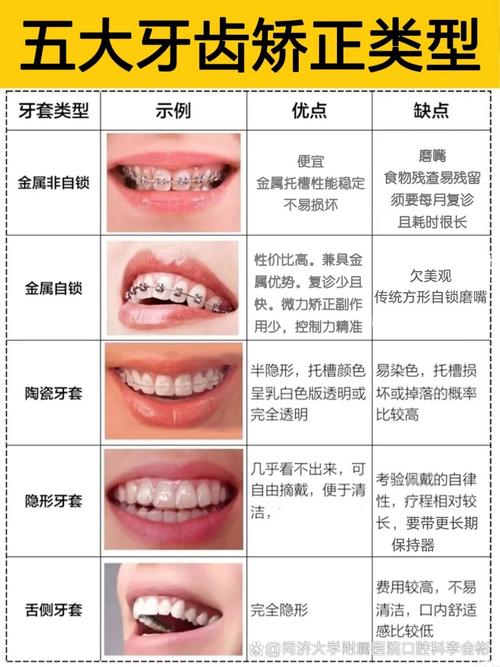牙齿矫正过程多久-图1 牙齿矫正过程多久-图1