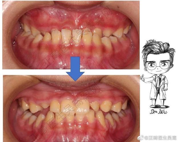 南京7天矫正牙齿真的靠谱吗?效果与安全如何?-图2 南京7天矫正牙齿真的靠谱吗?效果与安全如何?-图2