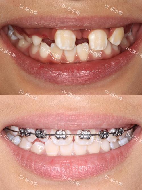 南京7天矫正牙齿真的靠谱吗?效果与安全如何?-图1 南京7天矫正牙齿真的靠谱吗?效果与安全如何?-图1