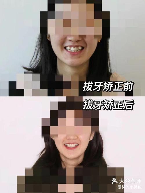 矫正牙齿后的感受-图1