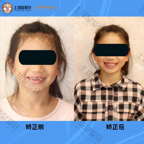 上海小儿牙齿矫正,几岁开始矫正效果最佳?-图3 上海小儿牙齿矫正,几岁开始矫正效果最佳?-图3