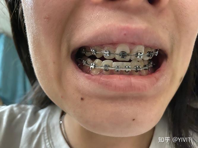 矫正牙齿钢丝松了-图3