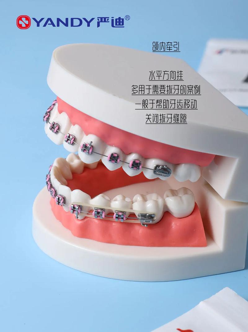 牙齿矫正皮筋牵引有何作用？如何正确使用？-图2