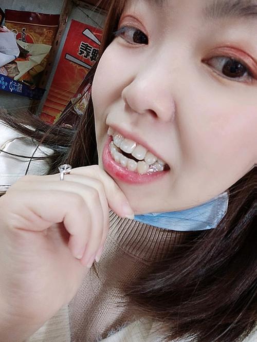 隐形矫正牙齿视频能看清牙齿矫正全过程和效果吗?-图2 隐形矫正牙齿视频能看清牙齿矫正全过程和效果吗?-图2