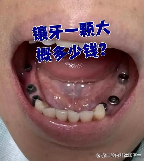 上海矫正牙齿与镶牙，哪种更适合？-图3