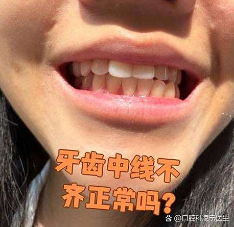 矫正牙齿中缝不齐,是什么原因导致的?-图3 矫正牙齿中缝不齐,是什么原因导致的?-图3