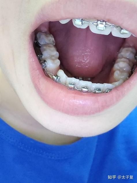 矫正牙齿垫高掉了-图1