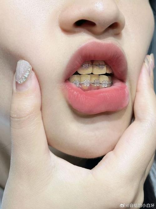 牙齿矫正后牙变黄？矫正器还是护理惹的祸？-图1