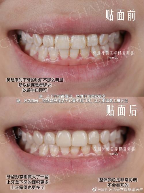 牙齿矫正后牙变黄？矫正器还是护理惹的祸？-图2