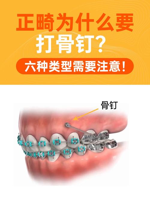 矫正牙齿要打骨钉-图3 矫正牙齿要打骨钉-图3