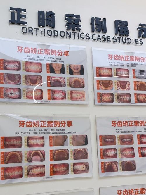 牙齿矫正设计方案如何制定才能兼顾效果与舒适?-图3 牙齿矫正设计方案如何制定才能兼顾效果与舒适?-图3