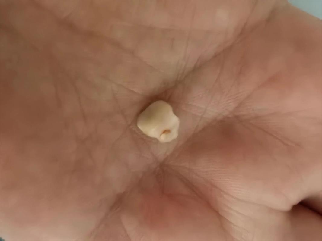 矫正牙齿后牙花掉了,该怎么办?-图3 矫正牙齿后牙花掉了,该怎么办?-图3