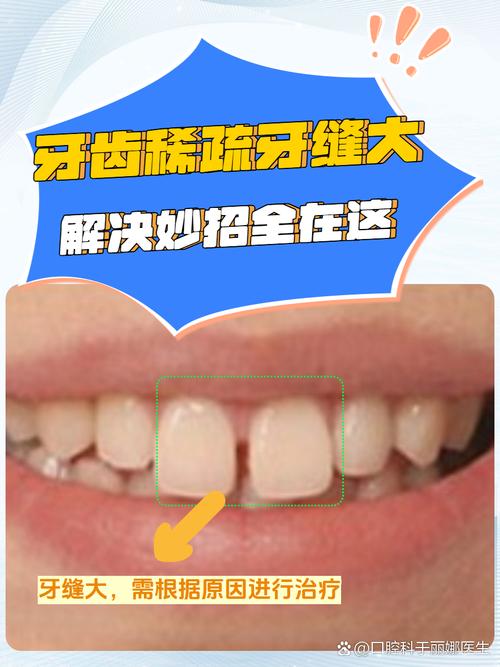 牙齿稀疏矫正容易吗？-图3