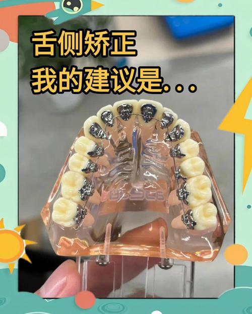 舌侧隐形矫正效果如何?适合哪些牙齿问题做?-图2 舌侧隐形矫正效果如何?适合哪些牙齿问题做?-图2