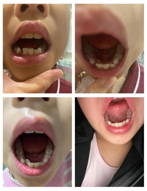 小s女儿矫正牙齿-图1 小s女儿矫正牙齿-图1