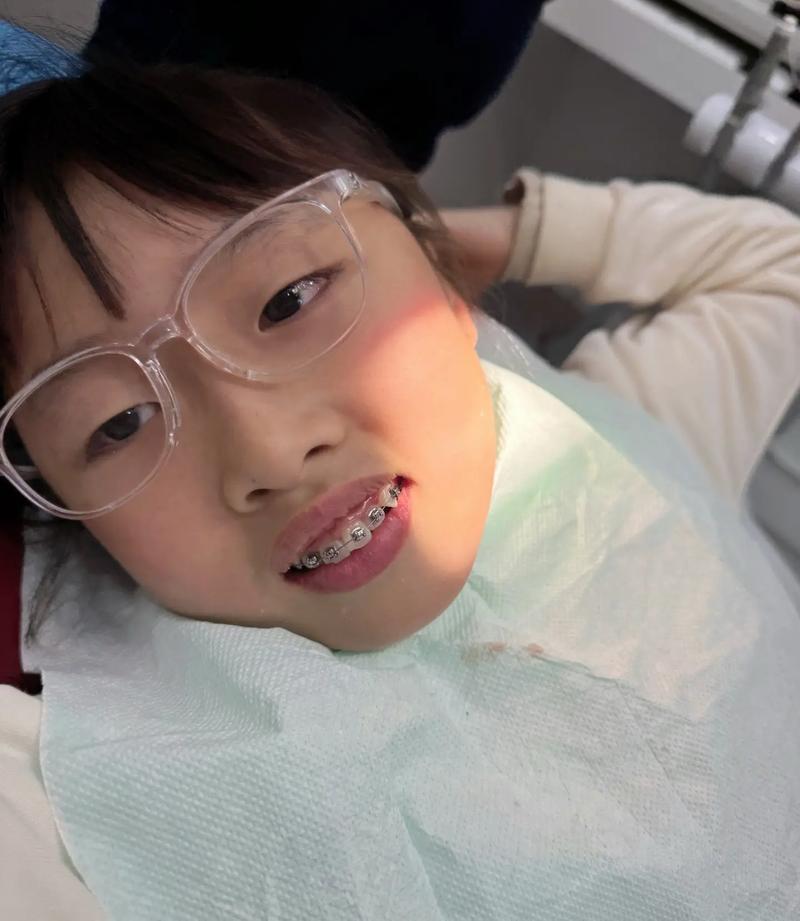 小s女儿矫正牙齿-图3 小s女儿矫正牙齿-图3