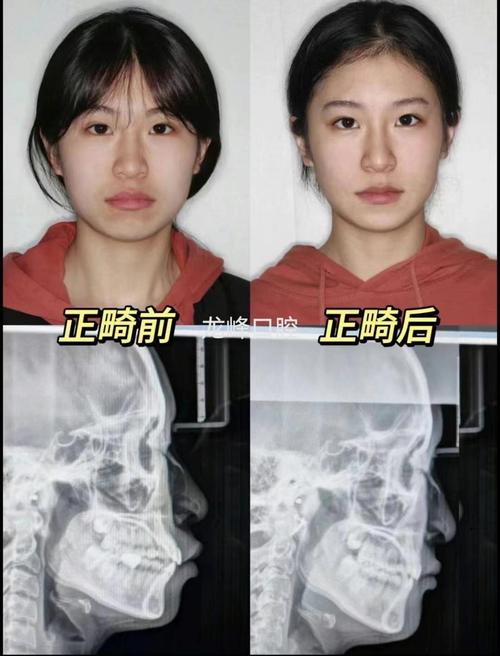 牙齿矫正后脸变小-图2