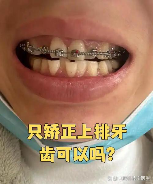 牙齿矫正只做上排,效果真的能好吗?-图3 牙齿矫正只做上排,效果真的能好吗?-图3