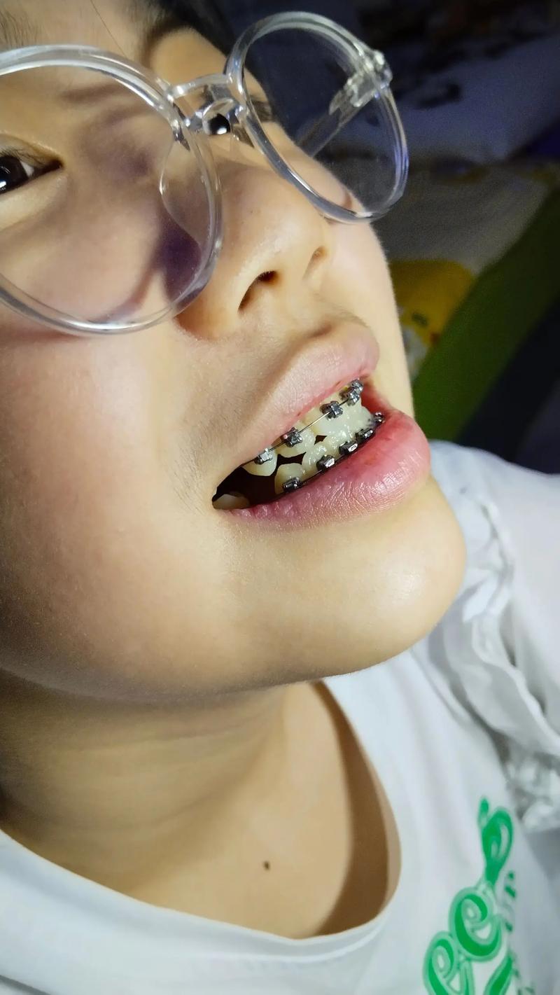 蚌埠二院矫正牙齿效果如何？值得信赖吗？-图3