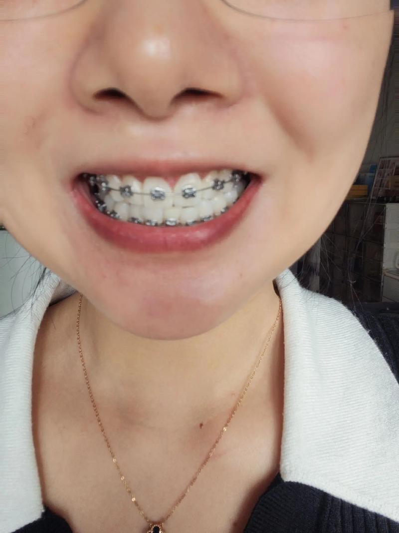 牙齿矫正钢丝脱落了，该怎么处理？-图3