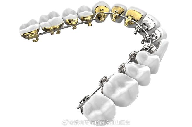 牙齿矫正托槽品牌怎么选?不同品牌效果和价格差异大吗?-图3 牙齿矫正托槽品牌怎么选?不同品牌效果和价格差异大吗?-图3