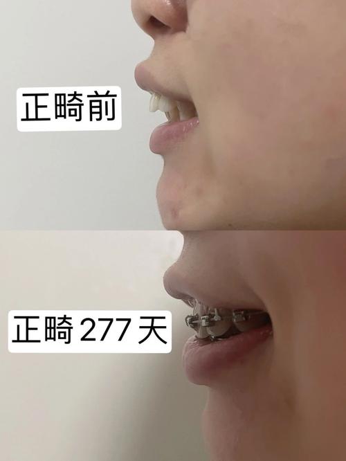 杭州畸形牙齿矫正效果怎样?哪种方法靠谱?-图1 杭州畸形牙齿矫正效果怎样?哪种方法靠谱?-图1