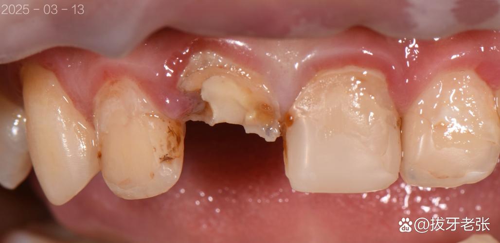 矫正牙齿门牙掉了-图2