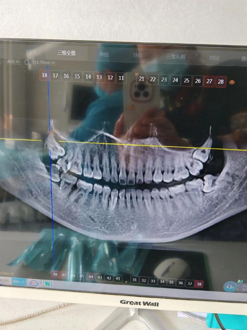 二次矫正拔牙，必须重新拔牙吗？-图3