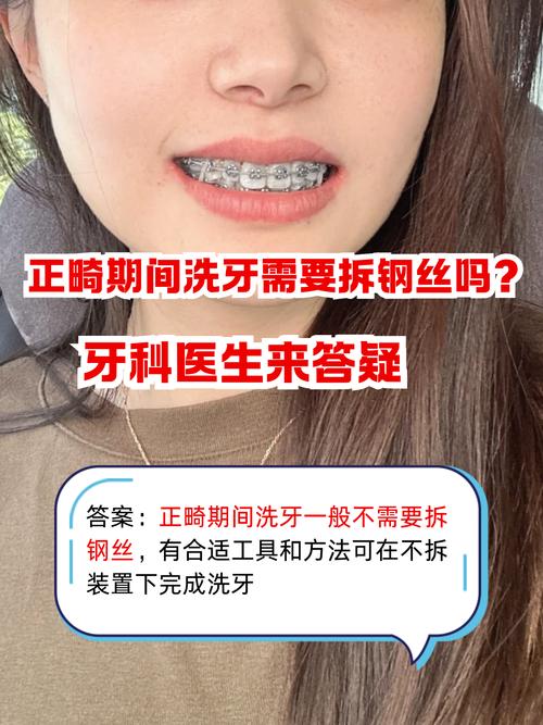矫正牙齿后，矫正器摘掉后牙齿还需要洗牙吗？-图2