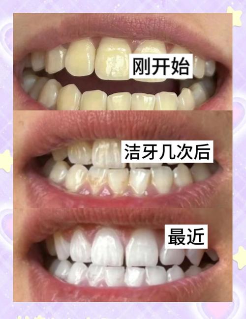 矫正牙齿后,矫正器摘掉后牙齿还需要洗牙吗?-图3 矫正牙齿后,矫正器摘掉后牙齿还需要洗牙吗?-图3