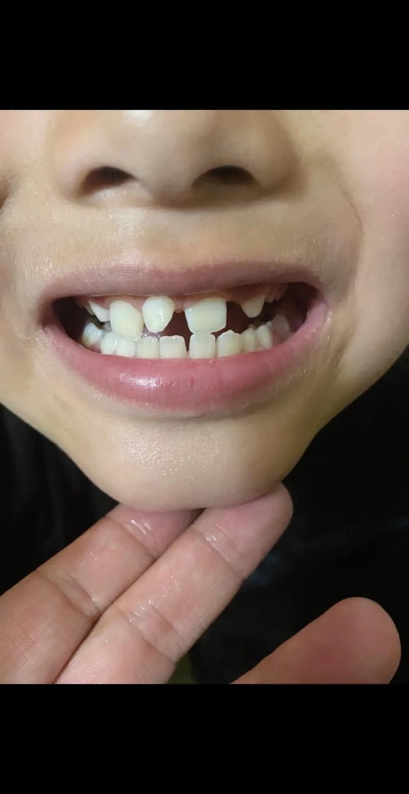 牙齿矫正后脸变歪？是矫正方式不当还是其他原因造成的？-图3