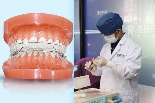 佳德口腔矫正牙齿效果好吗?适合哪些人?-图2 佳德口腔矫正牙齿效果好吗?适合哪些人?-图2