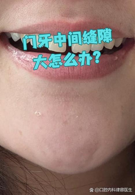 牙齿矫正完有缝隙-图2 牙齿矫正完有缝隙-图2