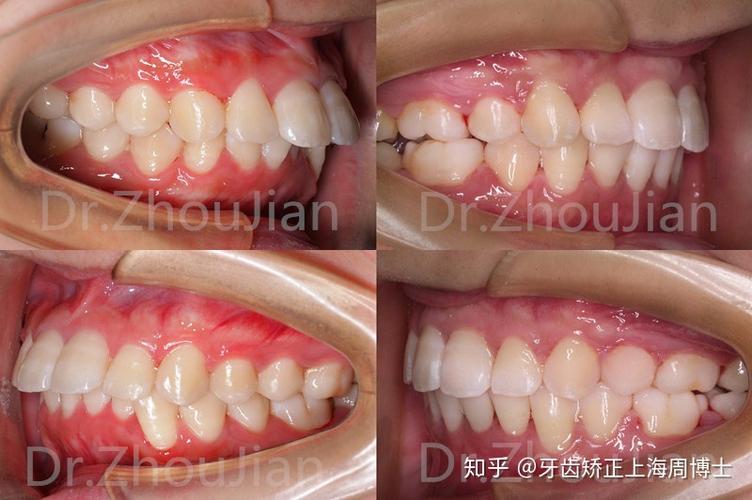 成人矫正牙齿后牙齿只剩24颗，是正常现象吗？-图1