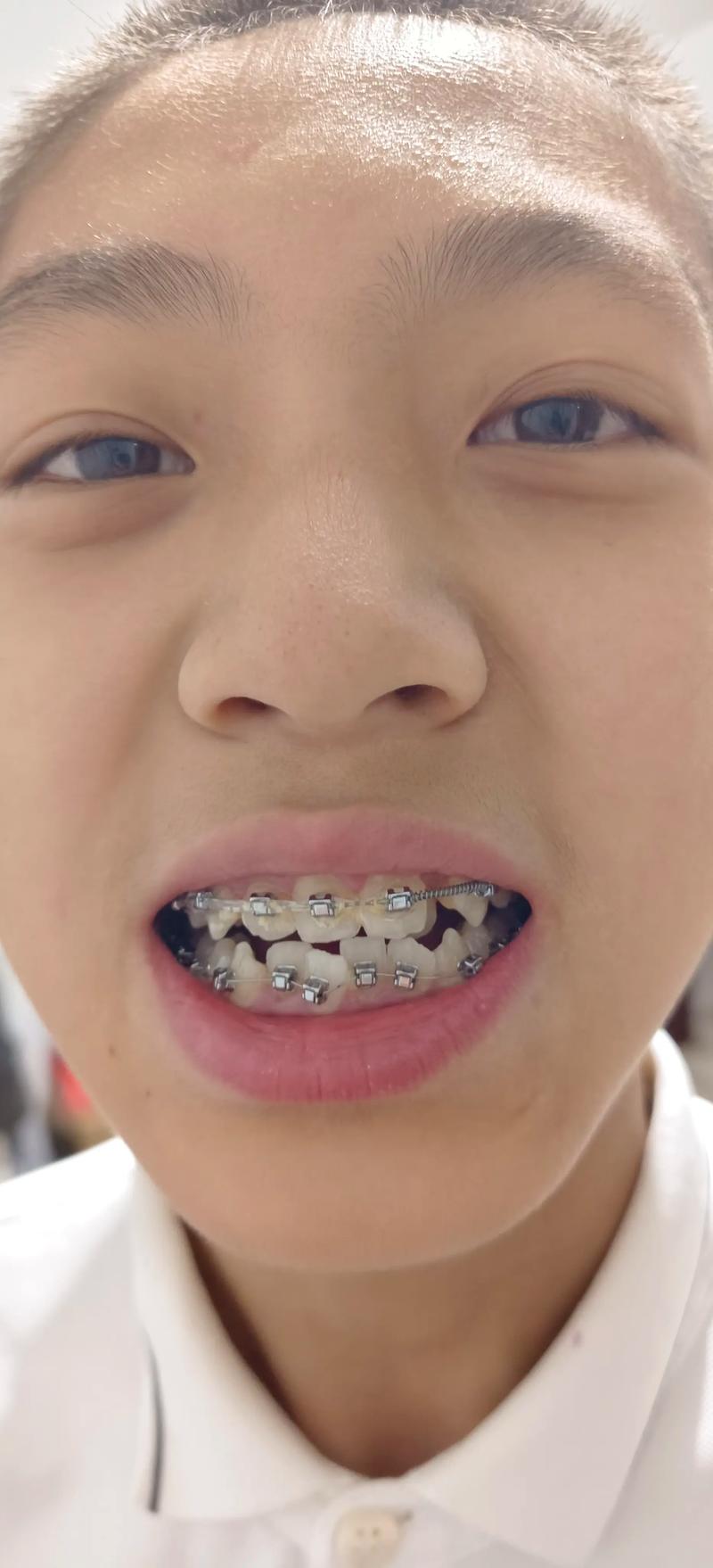 8岁儿童牙齿矫正,早干预还是等换牙?关键看哪些因素?-图1 8岁儿童牙齿矫正,早干预还是等换牙?关键看哪些因素?-图1