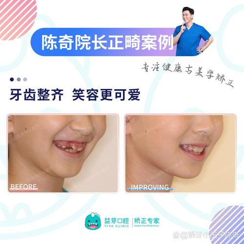 8岁儿童牙齿矫正,早干预还是等换牙?关键看哪些因素?-图3 8岁儿童牙齿矫正,早干预还是等换牙?关键看哪些因素?-图3